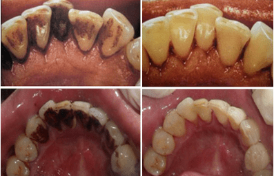 口腔|不到60元的电动牙刷，用起来竟然不输百元大牌！2分钟清洁整个口腔，性价比逆天！