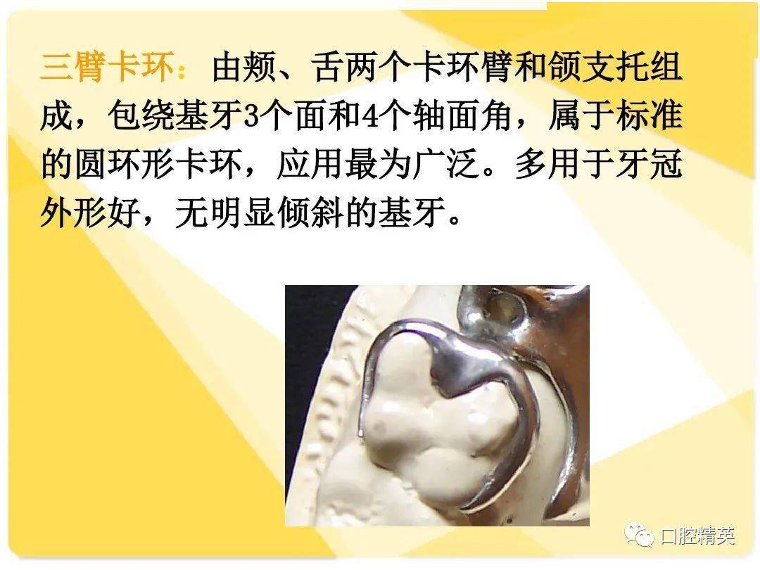 可摘局部义齿-结构