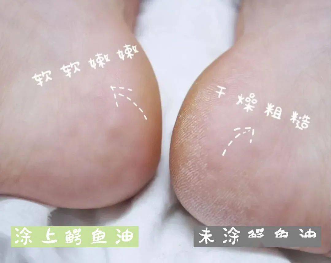 拖鞋|爱穿凉鞋、拖鞋出门的女人,脚上露出这个东西也太丑了吧~