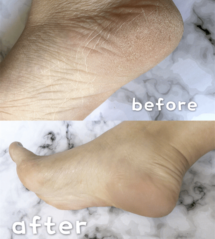 拖鞋|爱穿凉鞋、拖鞋出门的女人,脚上露出这个东西也太丑了吧~