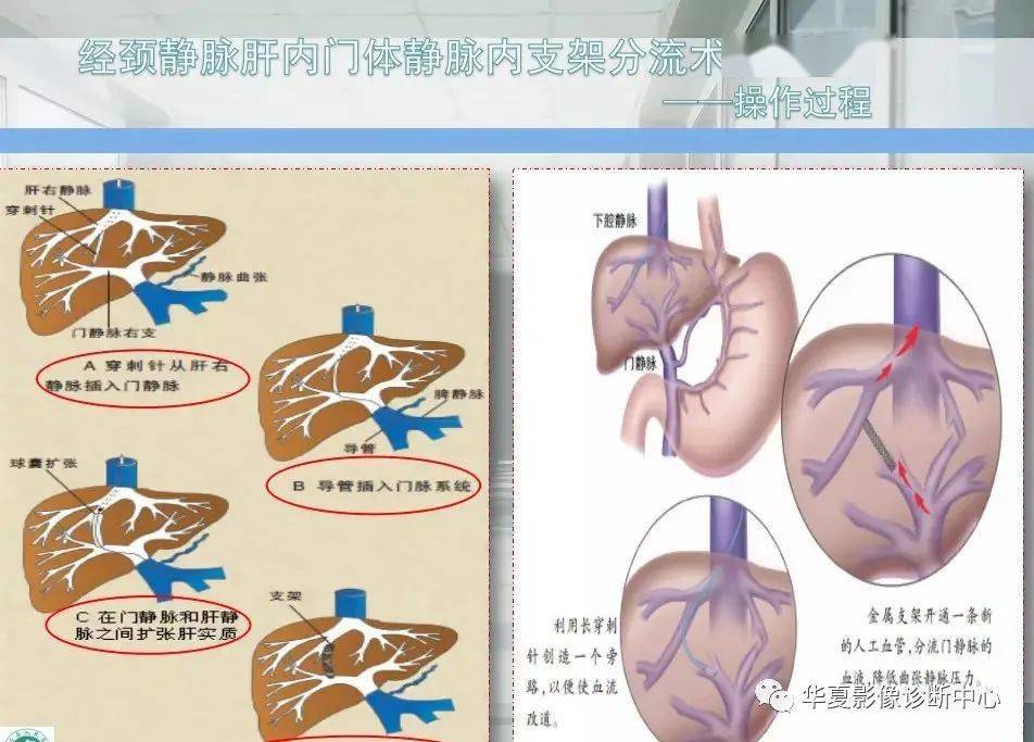 【观图学识】经颈静脉肝内门体分流术简易流程;介入剂量章使用