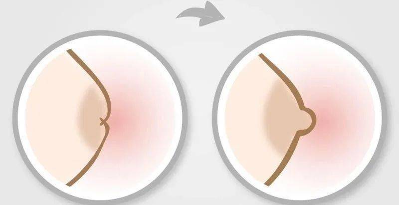 宝宝|宝妈必知！新生儿的八大特殊生理状态