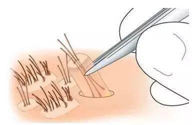 移植|国庆回去，我打算植发了！