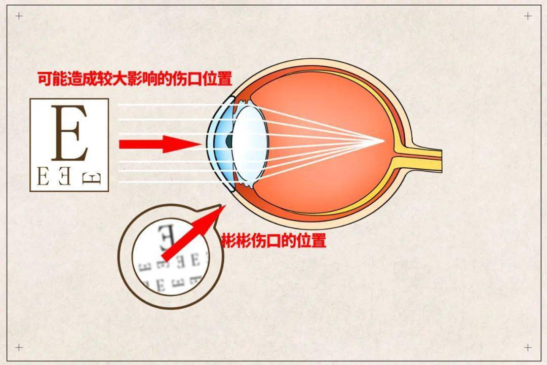 进行|“凶器”竟然是这么常见的东西，每个孩子都有6岁男童被扎穿眼睛