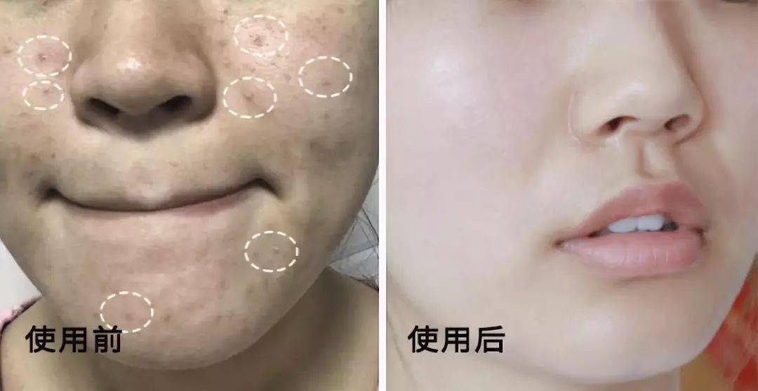 氨基酸|拒绝“螨虫脸”，5秒揉一揉，螨虫全出来了，痘痘黑头全没了！