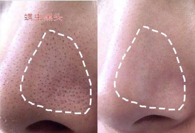 氨基酸|拒绝“螨虫脸”，5秒揉一揉，螨虫全出来了，痘痘黑头全没了！