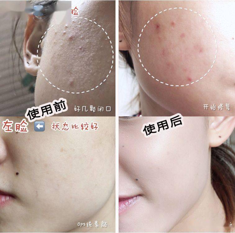 氨基酸|拒绝“螨虫脸”，5秒揉一揉，螨虫全出来了，痘痘黑头全没了！
