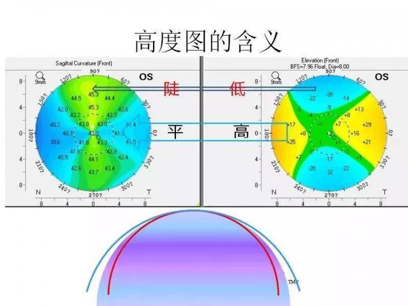 高度图:获知角膜各点形态后可以拟合出一个与角膜最贴合的球面,该