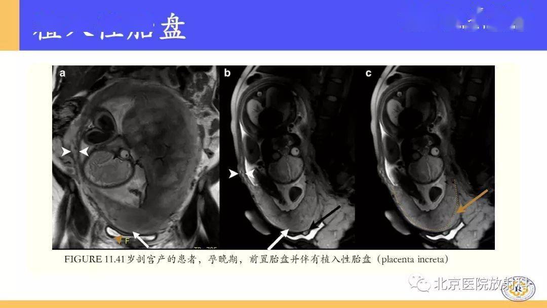 7.胎盘血肿6.妊娠产物滞留(rpoc)5.实性肿瘤4.滋养细胞疾病(gtds)3.