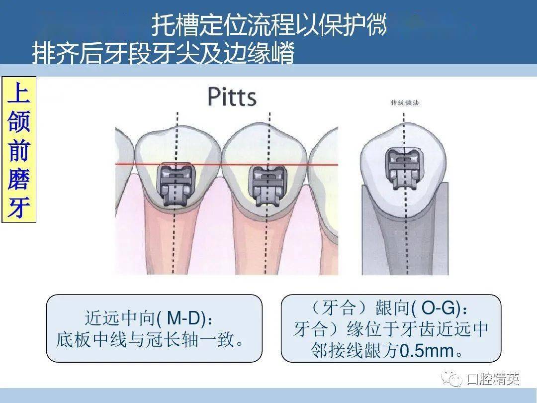 托槽粘结