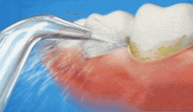 口腔|专业牙医也在用的冲牙器，1秒滋出牙缝残渣，爽！