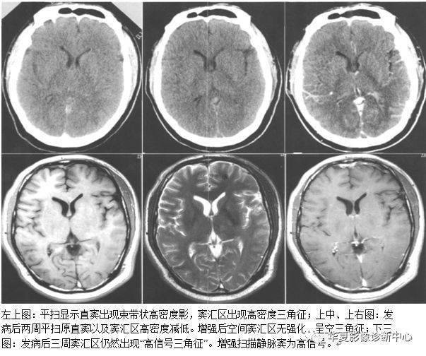 必须收藏的颅脑21种影像征像!_脑膜