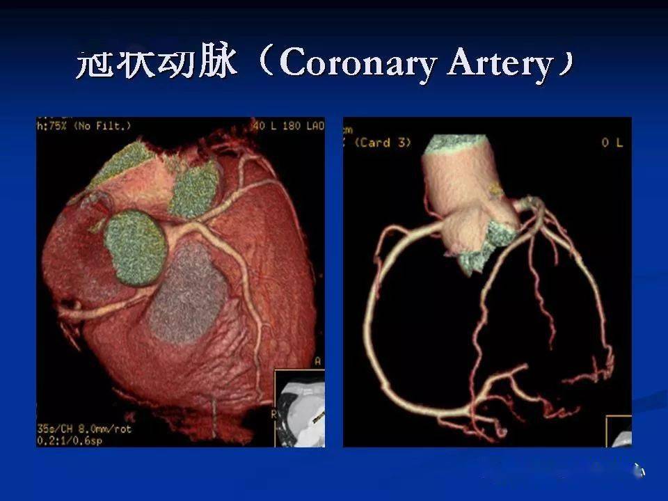 详细解读冠状动脉及冠心病ct