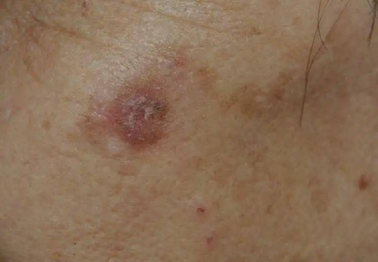 浅表型皮肤鳞状细胞癌(简称鳞癌)是起源于表皮或附属器角质形成细胞的