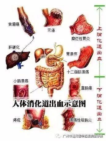 争分夺秒之如何快速识别急性消化道出血?