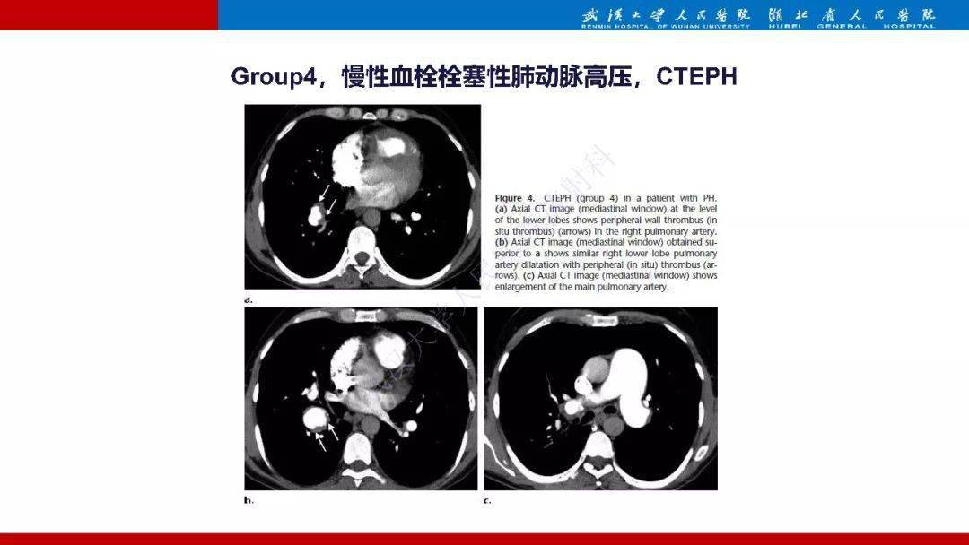 肺动脉高压临床分类及ct表现