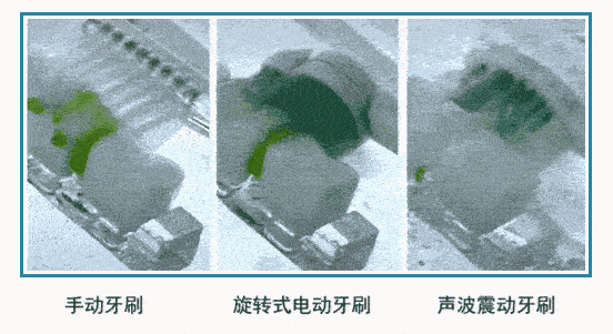 清洁|电动牙刷真的比普通牙刷好吗？我替你们问了医生