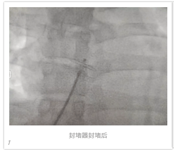 病因|反复脑梗，十年头疼，都是因为多长了一个“心眼”