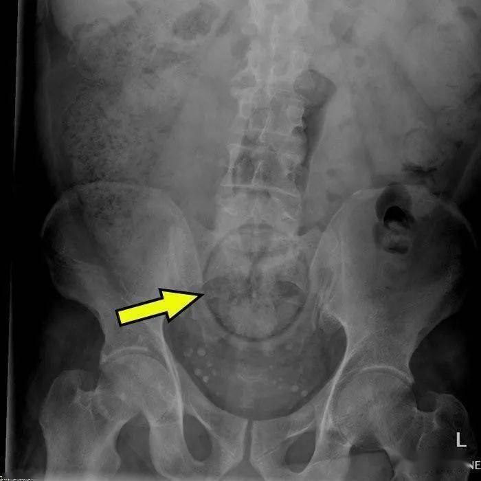 塞2斤金条藏8部手机…人类对肛门的探索太可怕了