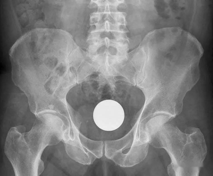 塞2斤金条藏8部手机…人类对肛门的探索太可怕了