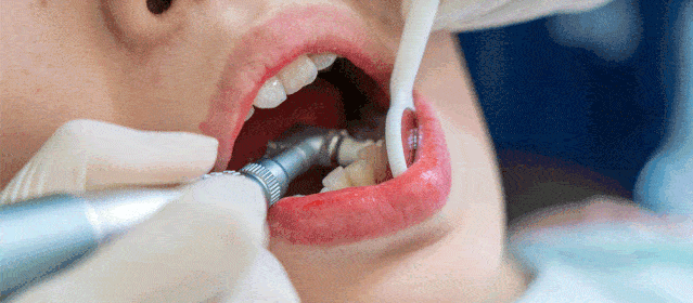 口腔|这波不亏！39.9元抢豪华洗牙套餐，告别“笑容尴尬症”！