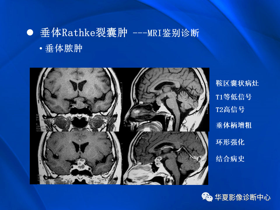 垂体rathke裂囊肿mr表现