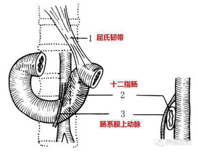 肠系膜上动脉压迫综合征与胡桃夹综合征