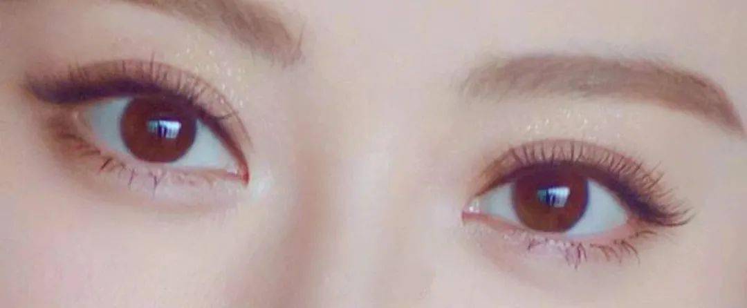 双杠|“悲伤蛙”，双杠眼……双眼皮到底怎么割？！