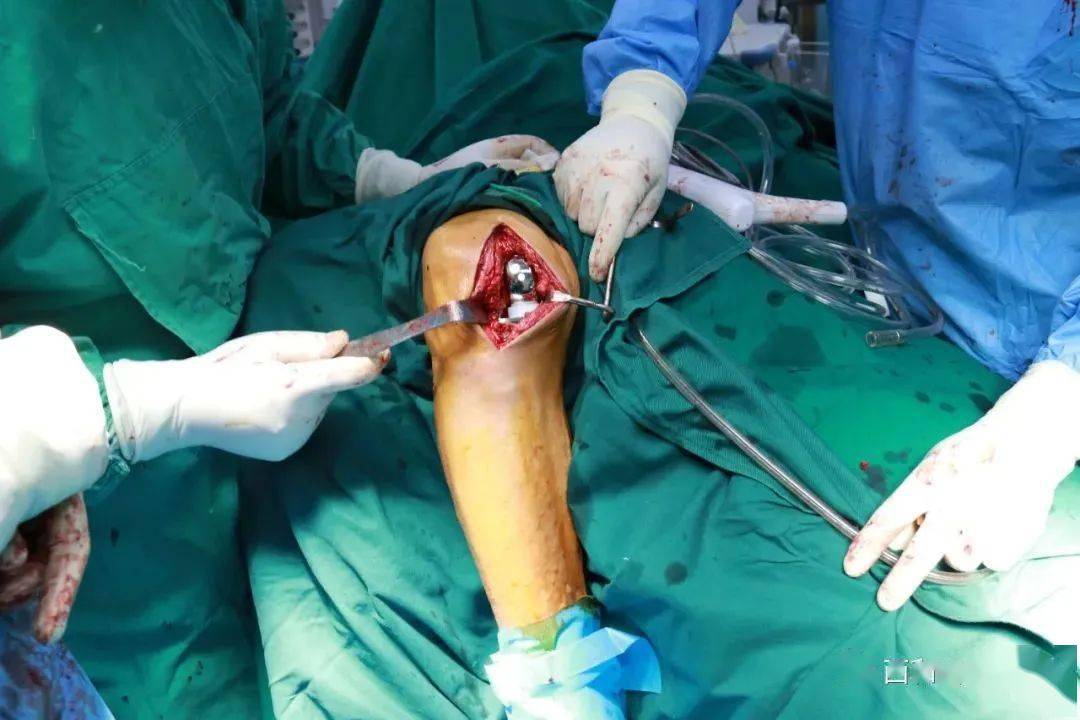 西和县中医院成功开展县内首例膝关节单髁置换术