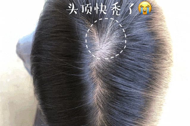 毛囊|流女星们的“狮子头”都是假象？录节目竟然当场掉下假发片，真相竟然是……
