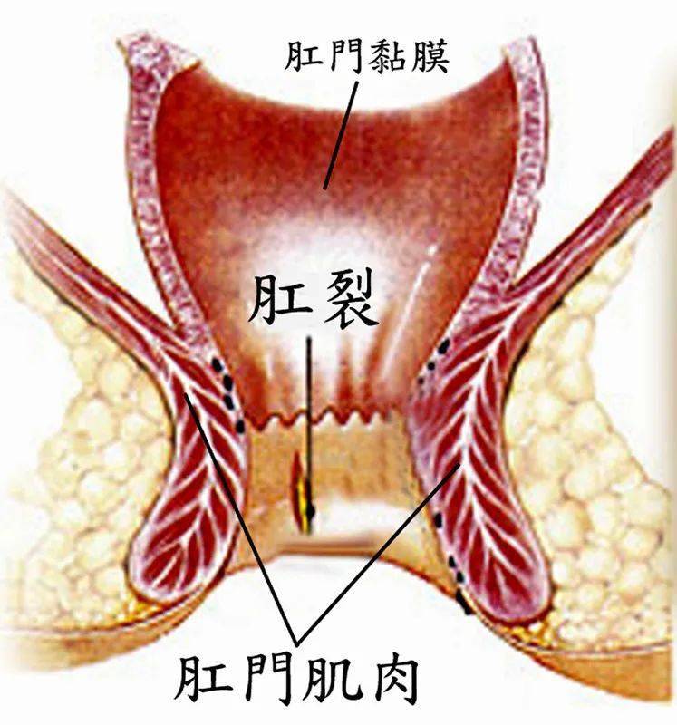 肛裂的主要临床表现为:肛门周期性疼痛,出血和便秘.