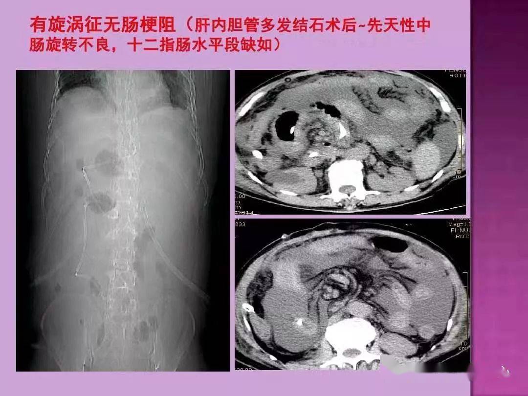 肠腔内梗阻:胆结石,粪石,异物,寄生虫腔内憩室 来源|华夏影像诊断