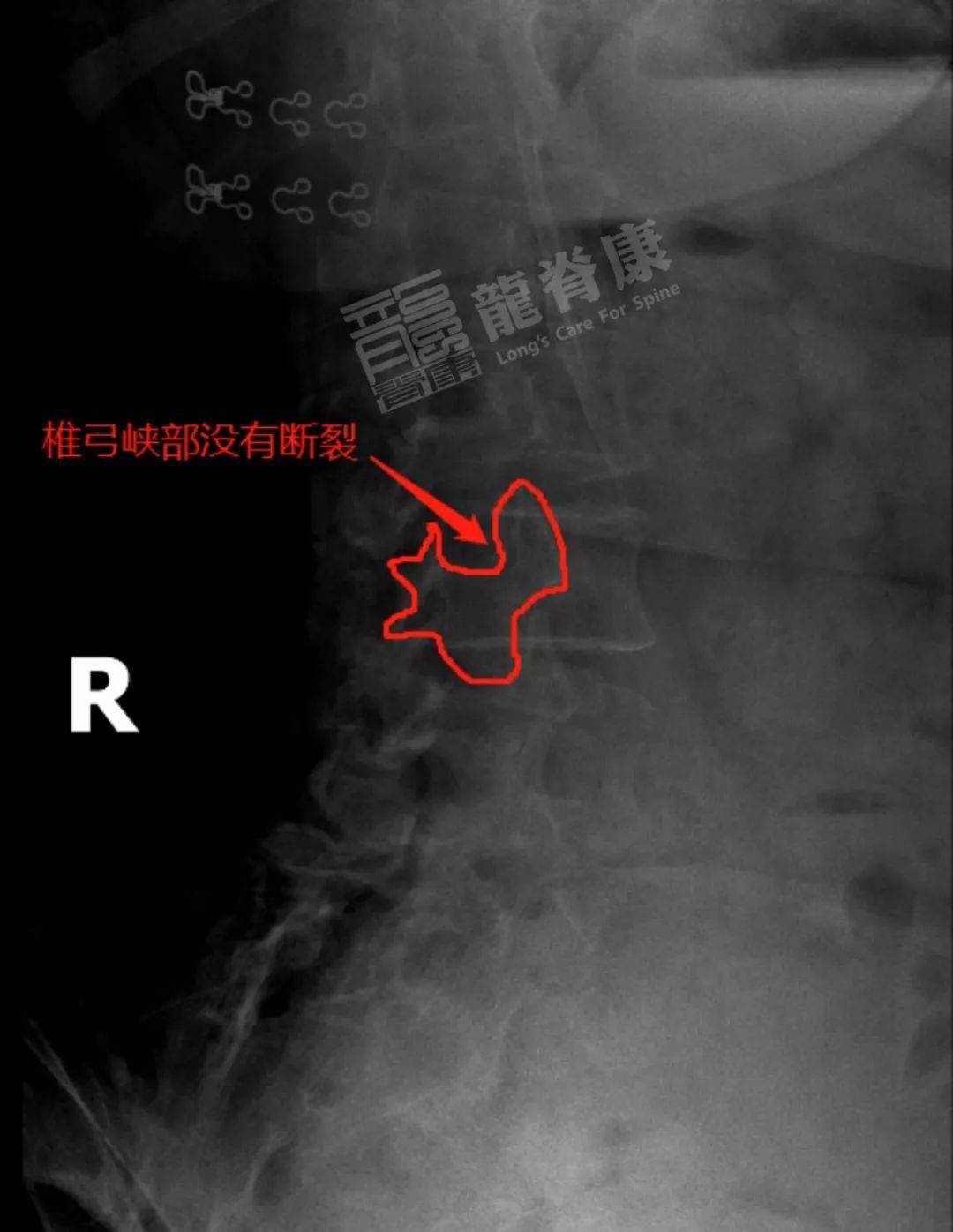 腰椎生理曲度增大,l4椎体向前ii°滑脱,未见峡部裂.