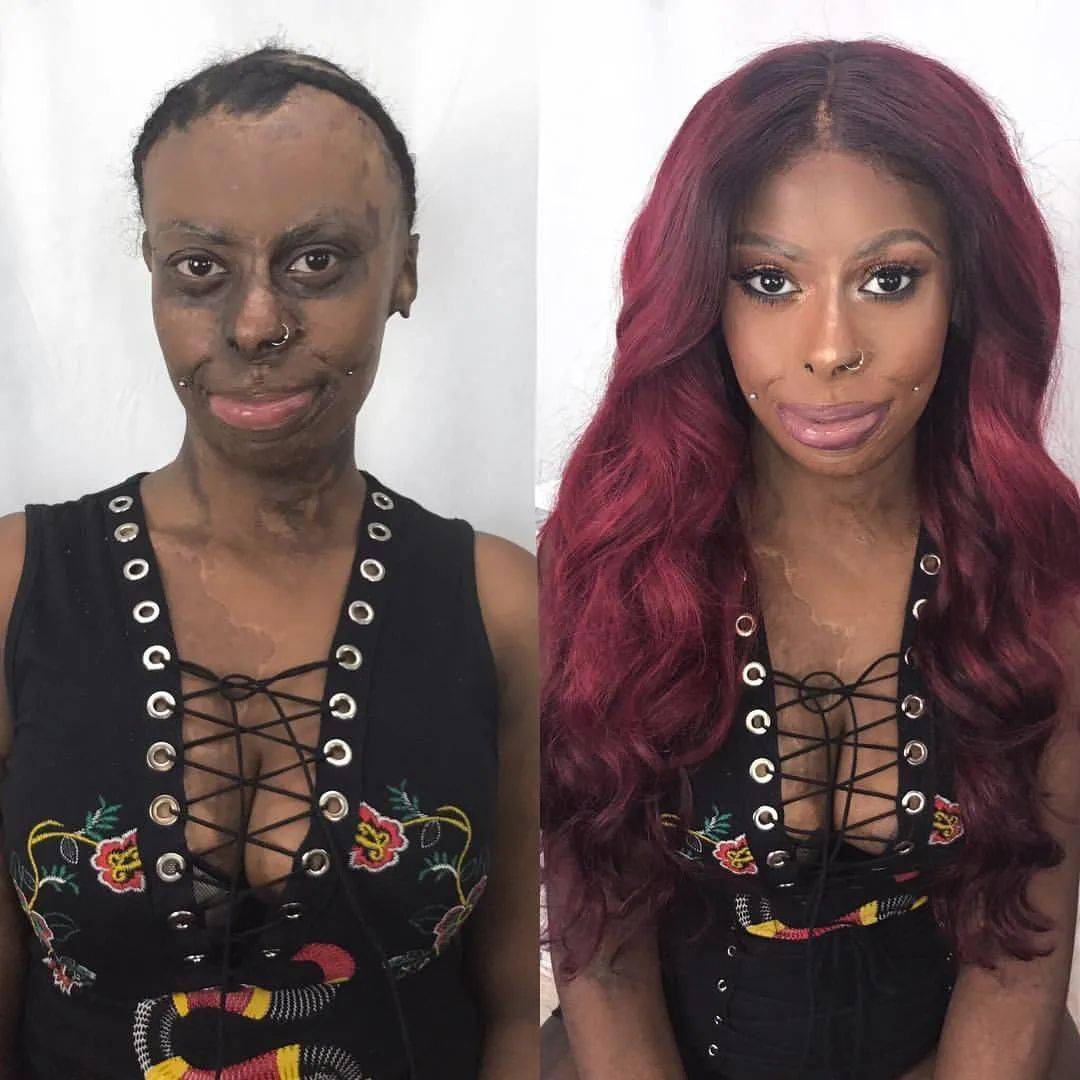 女童|非洲部落9岁毁容女童接受“换头术”，15年后现状曝光看哭网友：这才是顶级美人！