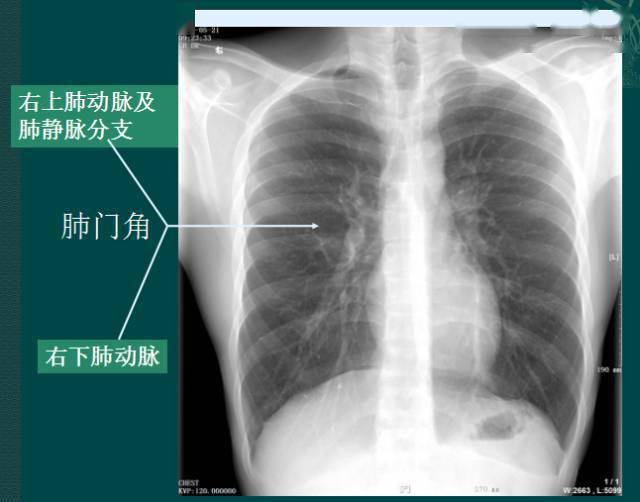 纵隔|读完此文，终于学会看胸片了