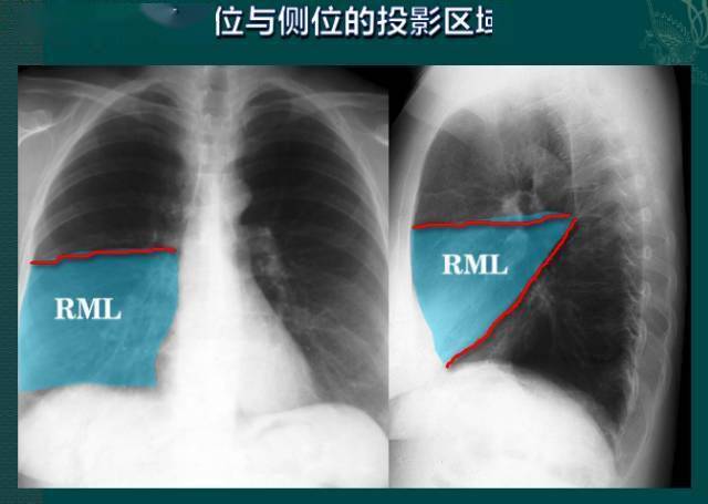 纵隔|读完此文，终于学会看胸片了