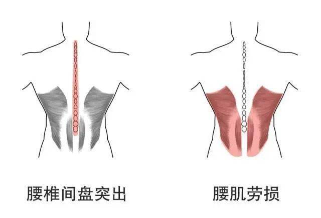 腰骶部疾病包括:坐骨神经痛,腰椎增生,腰肌和腰骶部劳损,腰椎间盘