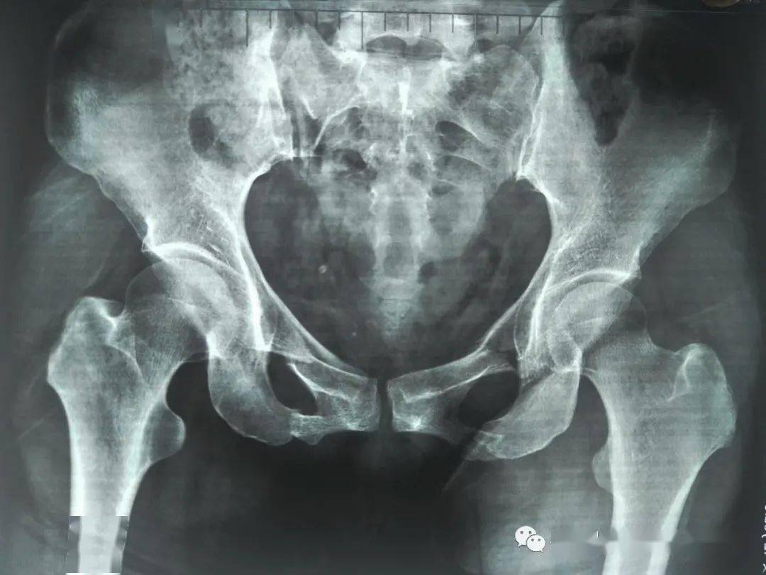 术前骨盆x光片