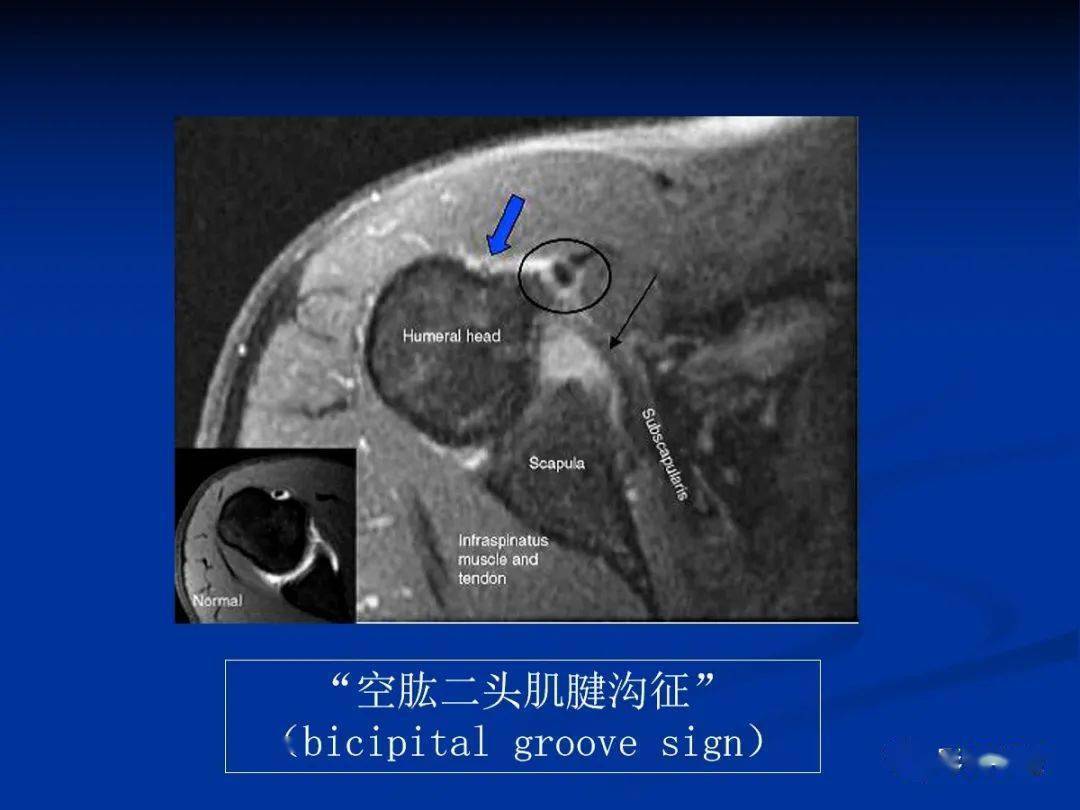 四个滑囊:肩峰下滑囊,三角肌下滑囊,喙突下滑囊,肩胛下滑囊.