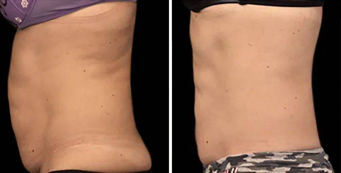 年轻人|年轻人做起医美来，到底有多拼？