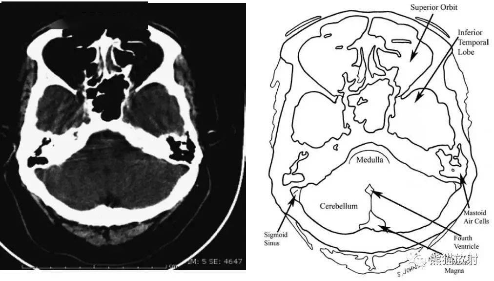 颅脑ct的正常解剖_大脑