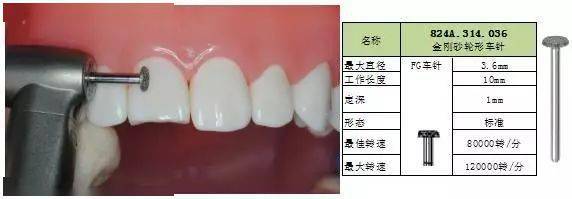【牙医学堂】牙体预备及全瓷牙备牙要求