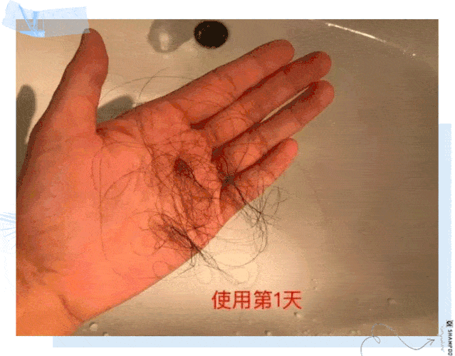 克兰|头上抠下的“白泥”，居然不是头皮屑？脱发头油都是因为它？