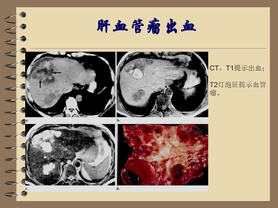 不典型肝脏血管瘤影像诊断