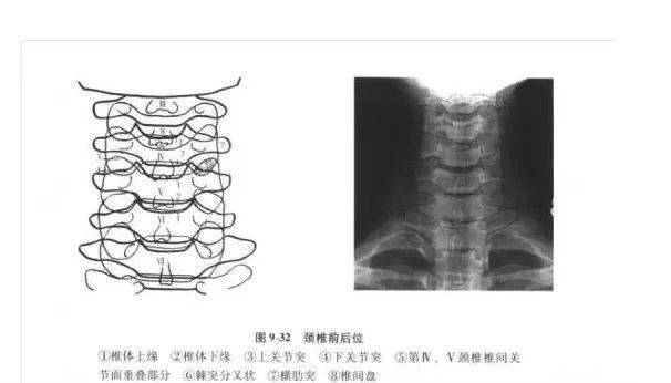 1 枢椎之齿突,2 寰枢之外侧块,3 寰枢关节,4 枢椎之椎体,5 第3颈椎 1