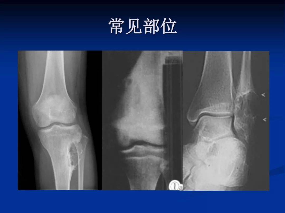 软骨粘液样纤维瘤影像学诊断