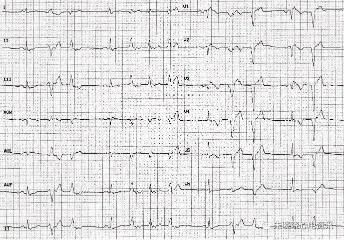 arvc患者心电图,除了典型的epsilon波外,窦律时v1-v3导联t波倒置