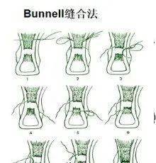 bunnell和改良kellser法常用,强度好,软组织并发症少,改良krackow法