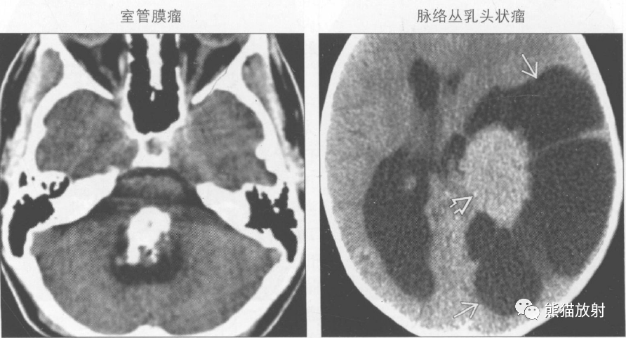 鉴别诊断丨脑室内钙化