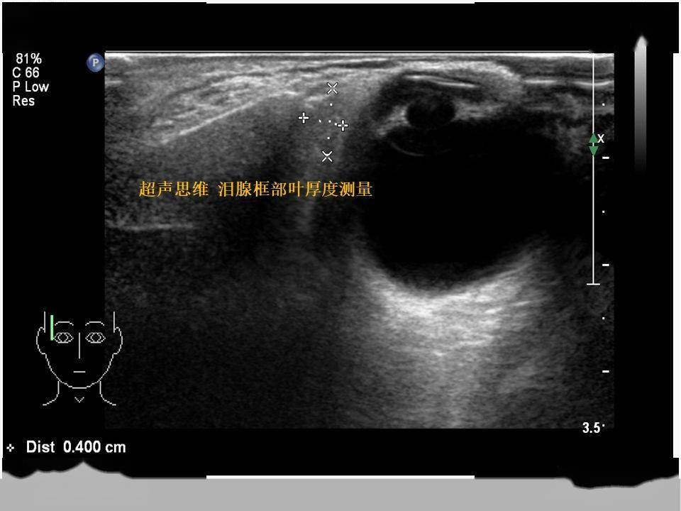 超声时间 泪腺-需要重新审视的器官